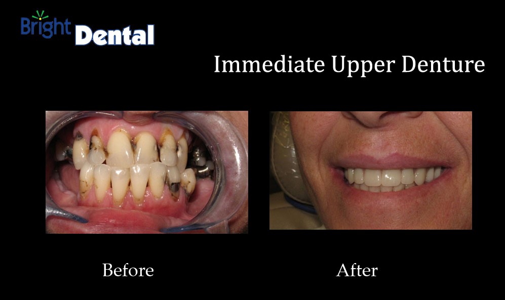 Upper And Lower Partial Dentures Reardan WA 99029